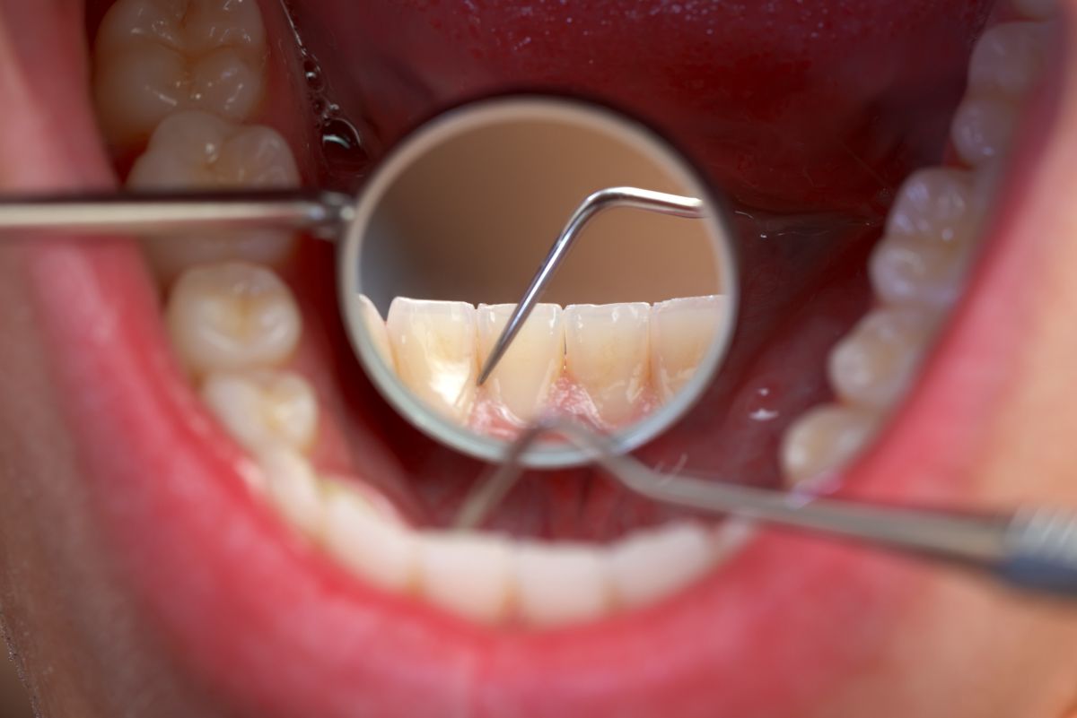 Jak poprawić wygląd naszych zębów?